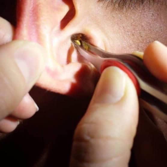 Hear4U Manual Ear Wax Removal