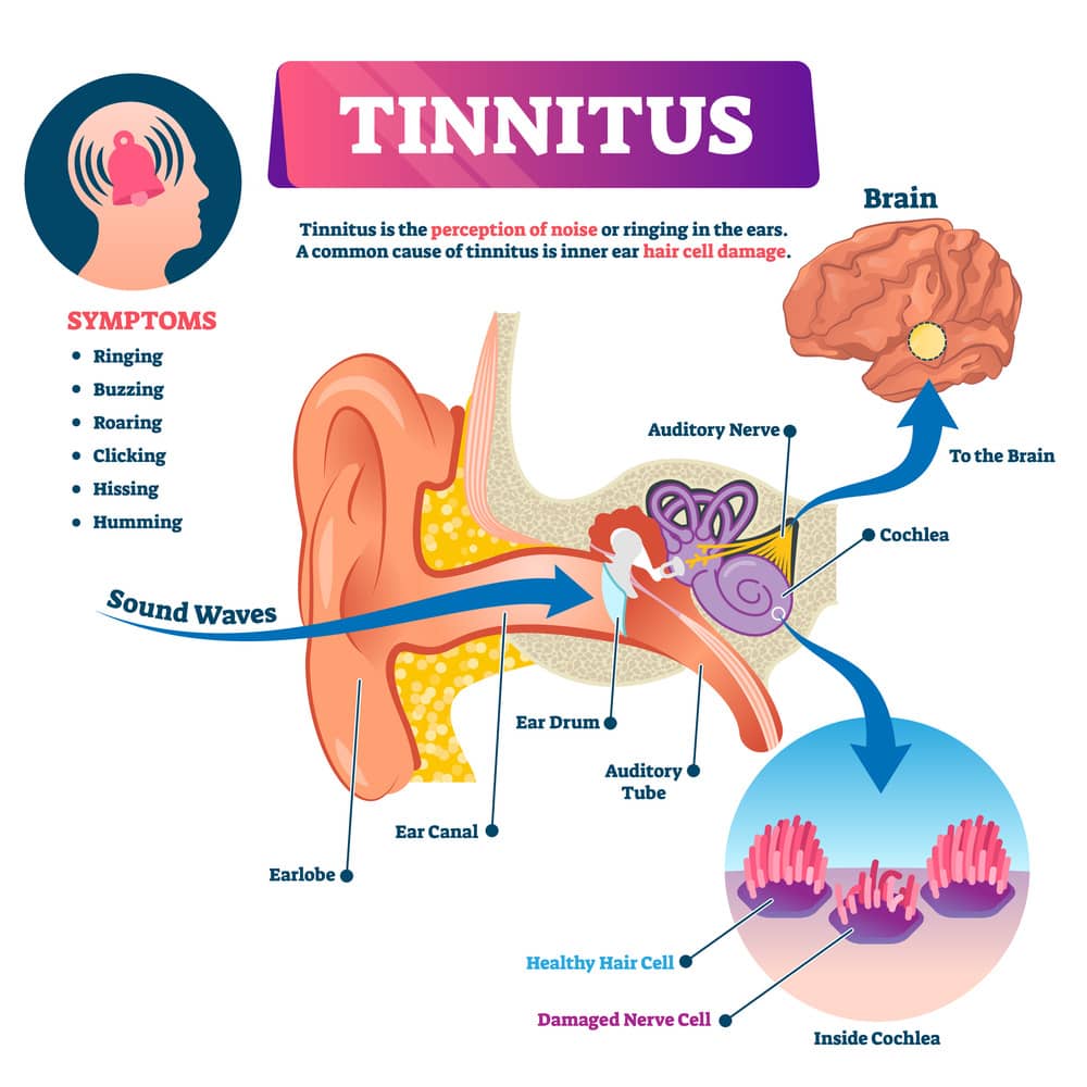 Cochlear nerve inflammation tinnitus hot sale