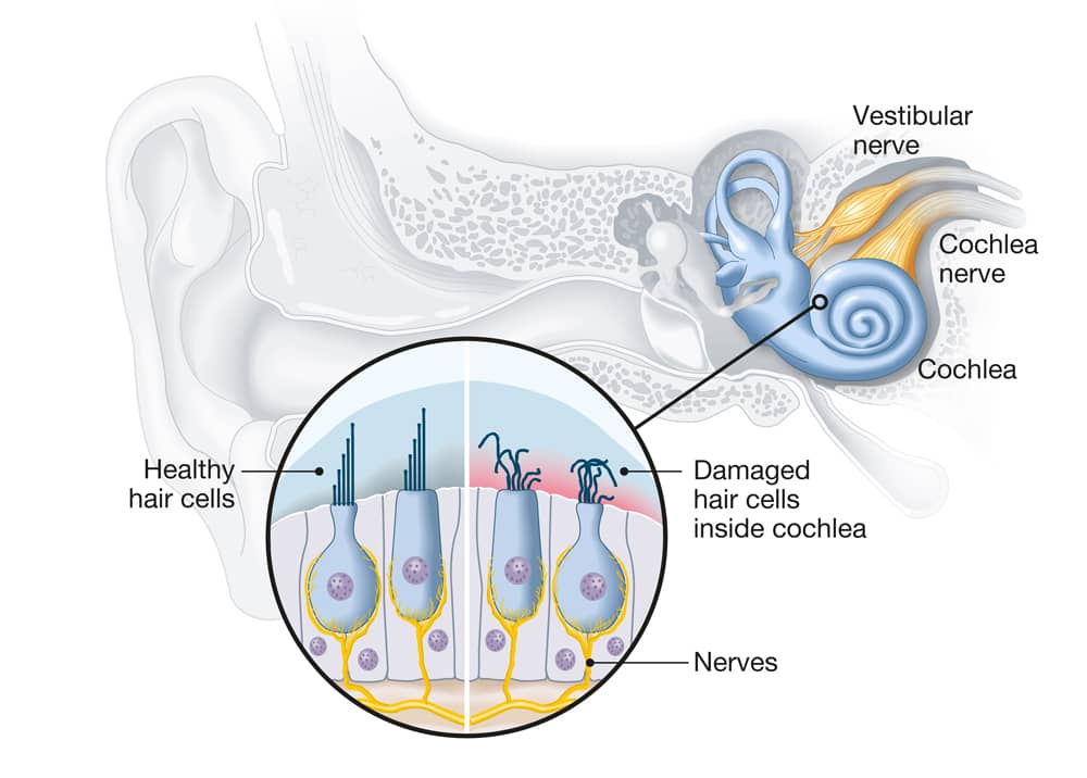 A visual representation of healthy and damaged hair cells inside the inner ear